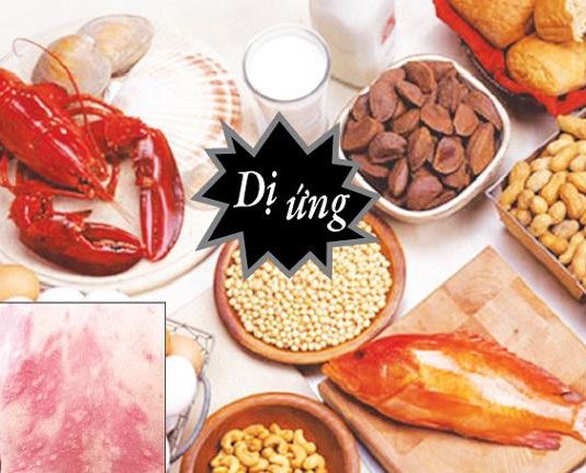 Cách nhận biết và phòng tránh dị ứng thức ăn